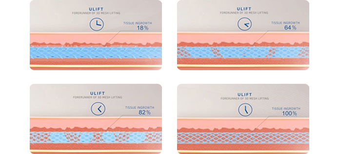 Tissue Ingrowth